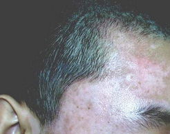 　　头部白癜风的发病症状有哪些?白癜风是一种顽固性的皮肤疾病，通常好发于比较显眼的部位，其中以头部为主，对于头部白癜风的症状，很多朋友不是十分了解，下面就请哈白癜风医院的医生为大家介绍一下：头部白癜风的发病症状有哪些?  　　头部白癜风的症状是白癜风白斑常发生于发际，多呈点状或带状，通常在初期的时候，白斑的数目比较小，不过白斑具有较强的扩散性，会随着患者的病情逐渐的融合成片，甚至布满整个头皮，头部白癜风还会累及头发，导致毛发变白。  　　由于头部处于暴露的位置，接触的有害物质比较多，所以患者护理起来也会比较麻烦，研究发现，男性的皮脂腺分泌较旺盛，外界活动多，接触粉尘或有害物质较多，易使头发沾染上污物。因此男性白癜风患者发病部位在头部的，要更加注重头部的清洁。  　　如果头部白癜风患者的这种情况没有得到及时的治疗，会引起更为严重的后果，皮损很可能可扩展至前发际处，侵蚀到前额数厘米。如果到了白癜风发展期，病情急性发展，患者颜面也可能出现白斑。  　　头部白癜风的发病症状有哪些?若您对白癜风方面有疑问以及顾虑的，可拨打我们的健康热线：400-678-8596 !或点击我们哈尔滨白癜风医院的在线咨询，将会有白癜风专科医生与您一对一交流!